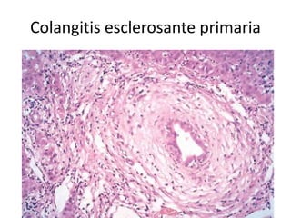 Colangitis esclerosante primaria
 