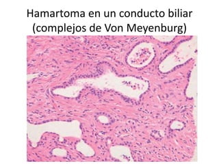 Hamartoma en un conducto biliar
(complejos de Von Meyenburg)
 