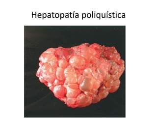 Hepatopatía poliquística
 