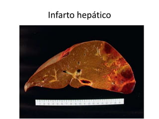 Infarto hepático
 