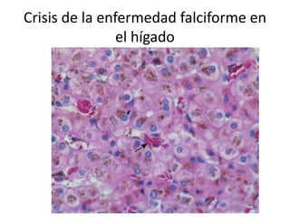 Crisis de la enfermedad falciforme en
el hígado
 