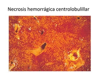 Necrosis hemorrágica centrolobulillar
 