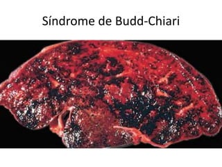 Síndrome de Budd-Chiari
 