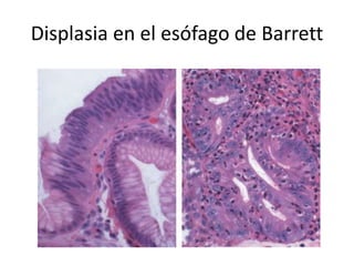 Displasia en el esófago de Barrett
 