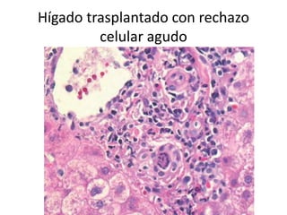 Hígado trasplantado con rechazo
celular agudo
 