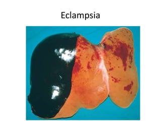 Eclampsia
 