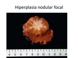 Hiperplasia nodular focal
 
