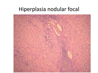 Hiperplasia nodular focal
 
