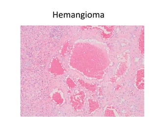 Hemangioma
 