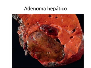 Adenoma hepático
 