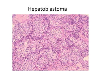 Hepatoblastoma
 