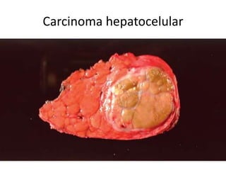 Carcinoma hepatocelular
 