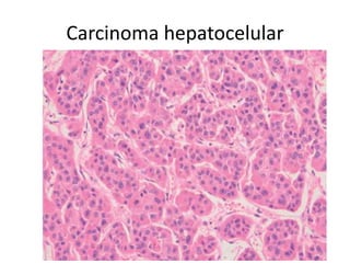 Carcinoma hepatocelular
 