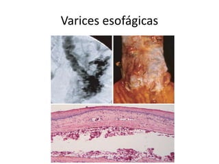 Varices esofágicas
 
