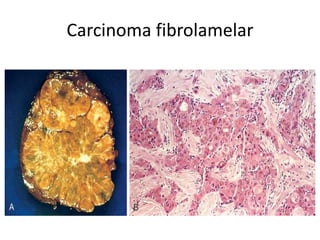 Carcinoma fibrolamelar
 