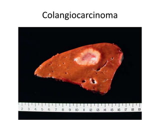 Colangiocarcinoma
 