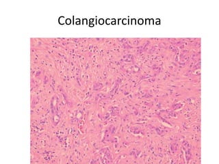 Colangiocarcinoma
 
