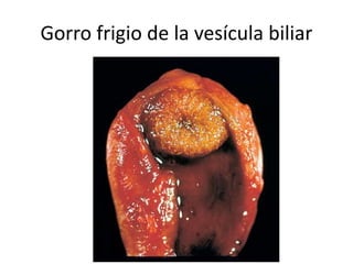 Gorro frigio de la vesícula biliar
 