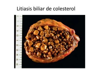Litiasis biliar de colesterol
 