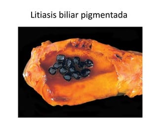 Litiasis biliar pigmentada
 