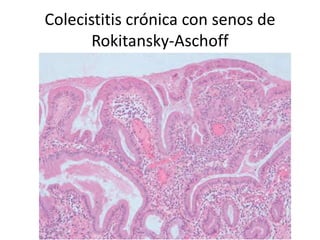 Colecistitis crónica con senos de
Rokitansky-Aschoff
 
