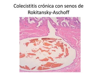 Colecistitis crónica con senos de
Rokitansky-Aschoff
 