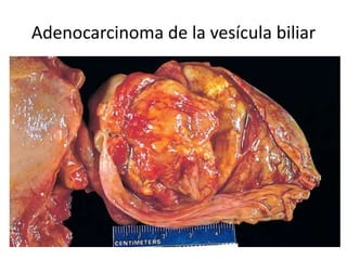 Adenocarcinoma de la vesícula biliar
 
