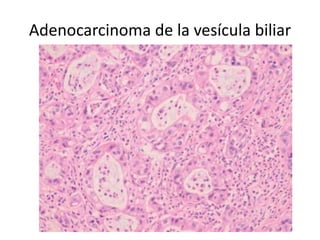 Adenocarcinoma de la vesícula biliar
 