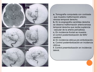 a. Tomografía computada con contraste
 que muestra malformación arterio-
venosa temporal derecho.
b. En la angiografía carotídea derecha
se observa malformación arteriovenosa
temporal derecha que recibe suplencia
 vascular de la arteria pericallosa.
c. En incidencia frontal se muestra
el control postembolización de MAV
cerebral.
d. En incidencia oblicua pre embolización.
e. Control postembolización en incidencia
oblicua.
f. Control preembolización en incidencia
lateral.
 