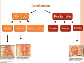 Clasificación


          Por tipo                            Por tamaño


Sacular   Fusiforme   Pseudo-aneurismas   Pequeños   Grandes   Gigantes
 