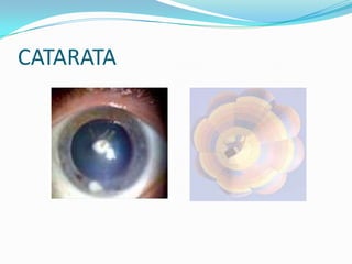 CATARATA
 