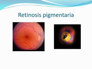 Retinosis pigmentaria
 