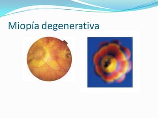 Miopía degenerativa
 