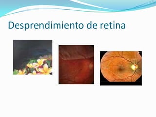 Desprendimiento de retina
 