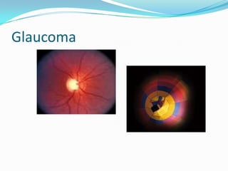 Glaucoma
 