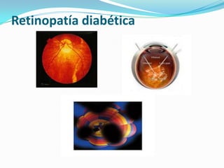 Retinopatía diabética
 