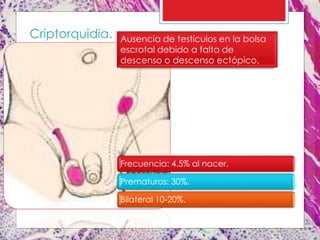 Ausencia de testículos en la bolsa
escrotal debido a falta de
descenso o descenso ectópico.
Criptorquidia.
Frecuencia: 4.5% al nacer.
Prematuros: 30%.
Bilateral 10-20%.
 