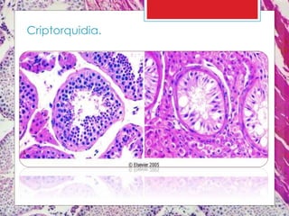 Criptorquidia.
 