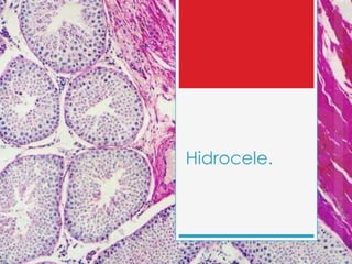 Hidrocele.
 