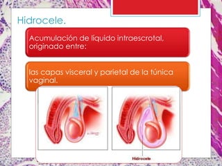 Hidrocele.
Acumulación de líquido intraescrotal,
originado entre:
las capas visceral y parietal de la túnica
vaginal.
 
