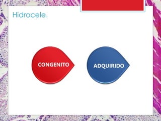 CONGENITO ADQUIRIDO
Hidrocele.
 