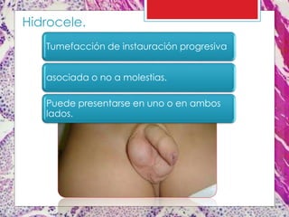 Tumefacción de instauración progresiva
asociada o no a molestias.
Puede presentarse en uno o en ambos
lados.
Hidrocele.
 