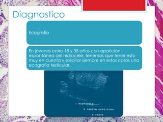 Diagnostico
Ecografía
En jóvenes entre 18 y 35 años con aparición
espontánea del hidrocele, tenemos que tener esto
muy en cuenta y solicitar siempre en estos casos una
ecografía testicular.
 