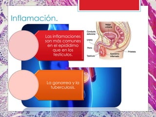 Inflamación.
Las inflamaciones
son más comunes
en el epidídimo
que en los
testículos.
La gonorrea y la
tuberculosis.
 