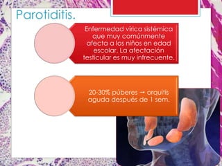 Parotiditis.
Enfermedad vírica sistémica
que muy comúnmente
afecta a los niños en edad
escolar. La afectación
testicular es muy infrecuente.
20-30% púberes  orquitis
aguda después de 1 sem.
 