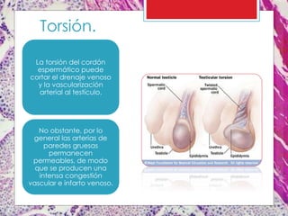 Torsión.
La torsión del cordón
espermático puede
cortar el drenaje venoso
y la vascularización
arterial al testículo.
No obstante, por lo
general las arterias de
paredes gruesas
permanecen
permeables, de modo
que se producen una
intensa congestión
vascular e infarto venoso.
 