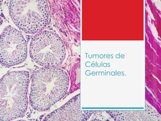 Tumores de
Células
Germinales.
 