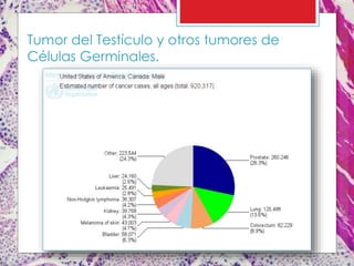 Tumor del Testículo y otros tumores de
Células Germinales.
 