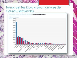 Tumor del Testículo y otros tumores de
Células Germinales.
 