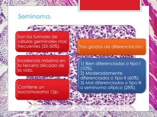 Son los tumores de
células germinales mas
frecuentes (35-50%).
Incidencia máxima en
la tercera década de
la vida.
Contiene un
isocromosoma 12p.
Seminoma.
Tres grados de diferenciación:
1) Bien diferenciados o tipo I
(10%).
2) Moderadamente
diferenciados o tipo II (60%).
3) Mal diferenciados o tipo III
o seminoma atípico (28%).
 